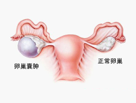 王振国：中医治疗卵巢囊肿方大全|医院学术交流