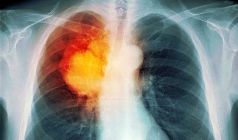 肺癌   百科
